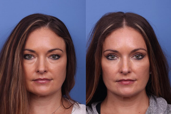 Blepharoplasty-1