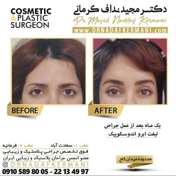 انجام لیفت شقیقه چه مزایایی دارد؟