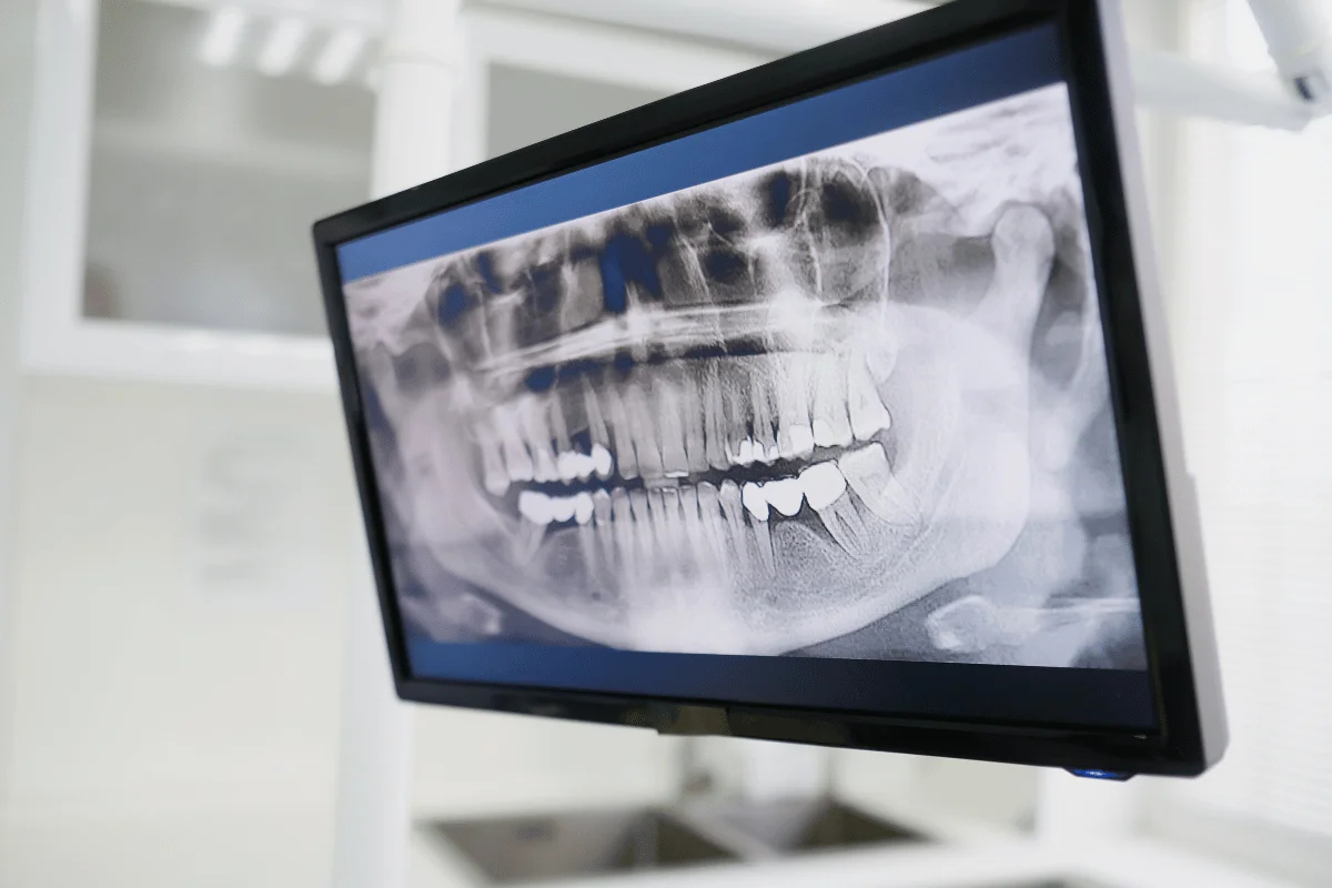 تصویربرداری CBCT دندان