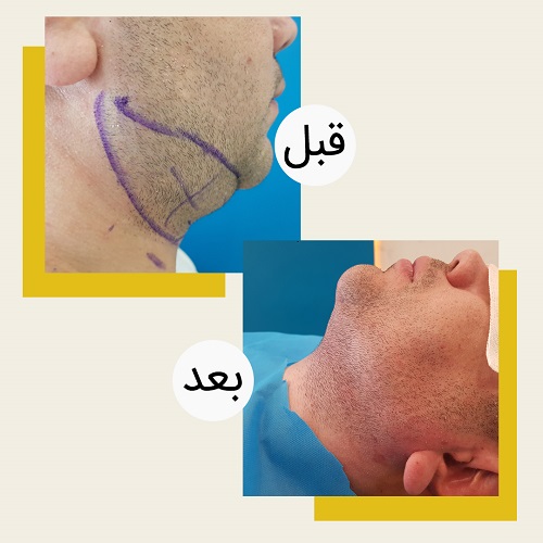 لیپوساکشن غبغب برای چه کسانی مناسب نیست؟