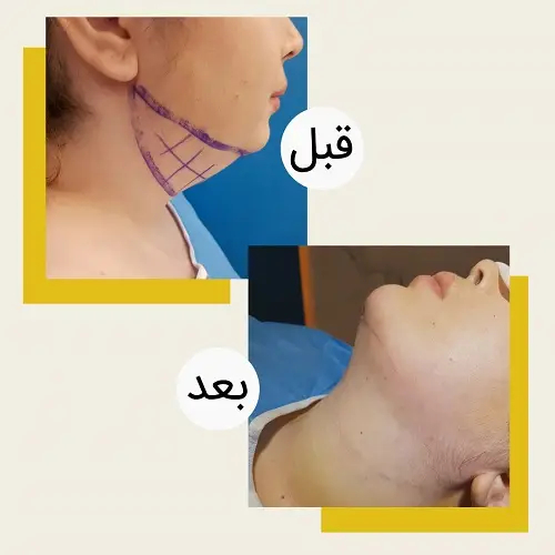 ساکشن غبغب چگونه انجام می‌شود؟